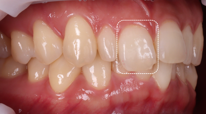 왜소치 레진으로 삭제 없이 예쁘게 관련 이미지 5