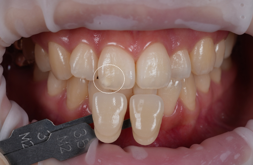 신논현치과 치아미백 누구나 예쁘게 하얗게 되는 건 아니다? 관련 이미지 2