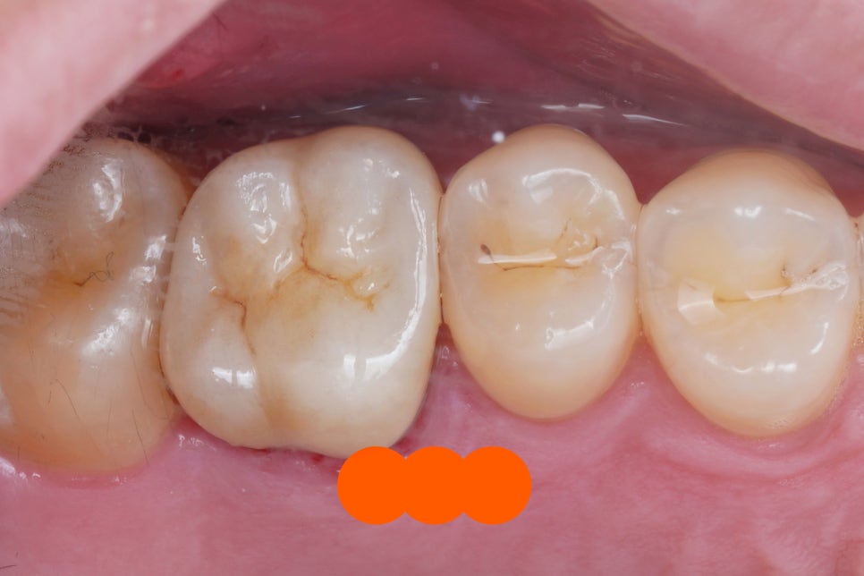 신경치료 후 크라운 씌운 치아 통증, 재신경치료 및 지르코니아 크라운 재치료 관련 이미지 5