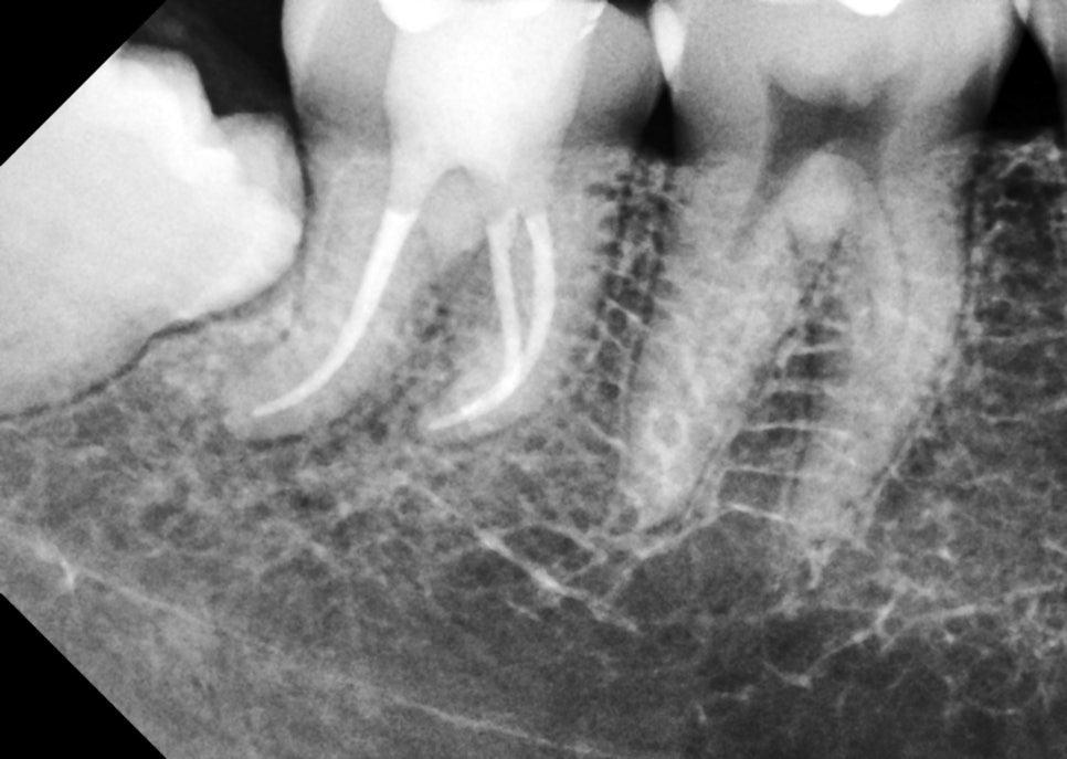 서초동치과 치아 삭제 원하지 않는다면 오버레이 하세요 관련 이미지 7
