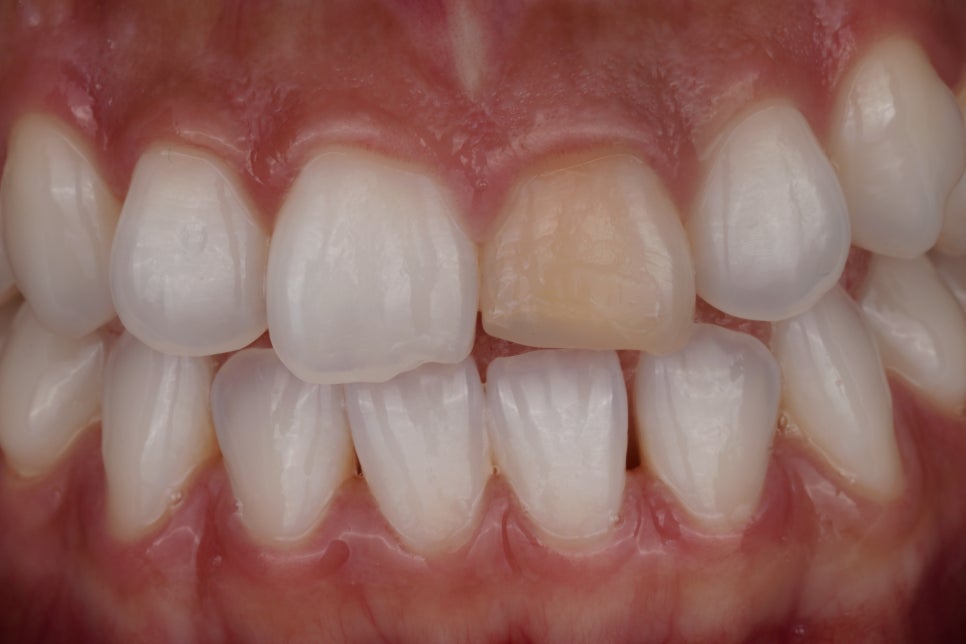 앞니 신경치료 변색 원인과 치료법인 실활치 미백 관련 이미지 1