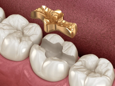 교대치과 신경치료 후 크라운 안 하고 오버레이로 보존 관련 이미지 7