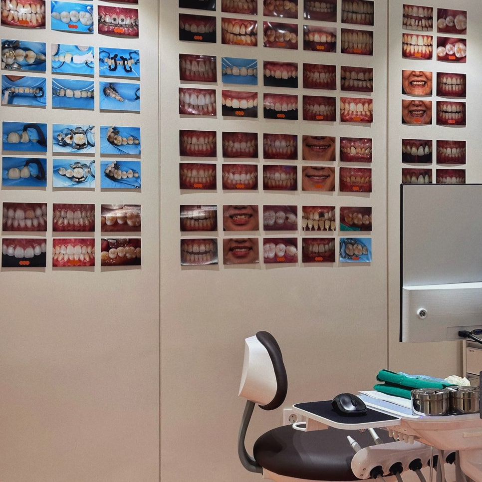 앞니 사이 벌어진 틈, 레진으로 당일치료가 가능할까요 관련 이미지 1