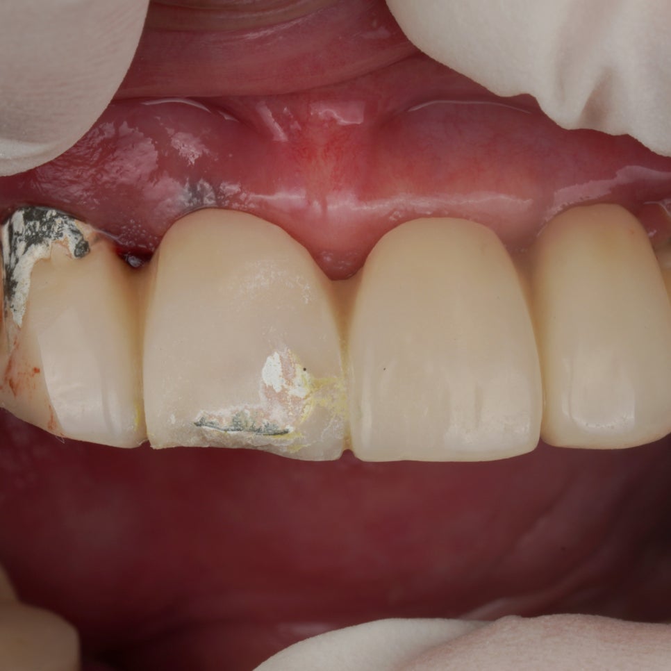 앞니 임플란트 PFM 보철 도자기 깨짐, 당일 수리해주는 서초 치과 관련 이미지 1