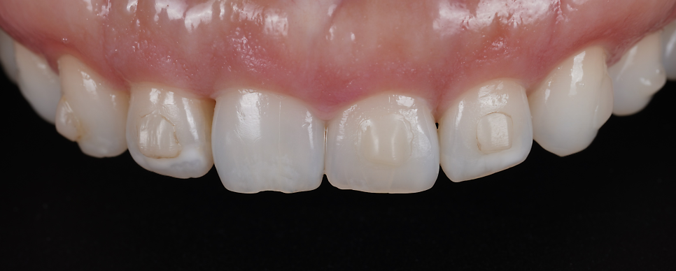 신사역치과 미국에서 교정 중이던 분 앞니 레진으로 고민 해결 관련 이미지 4