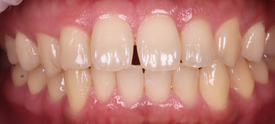 방배동치과 누렇고 벌어진 치아 미백과 레진 치료 관련 이미지 2