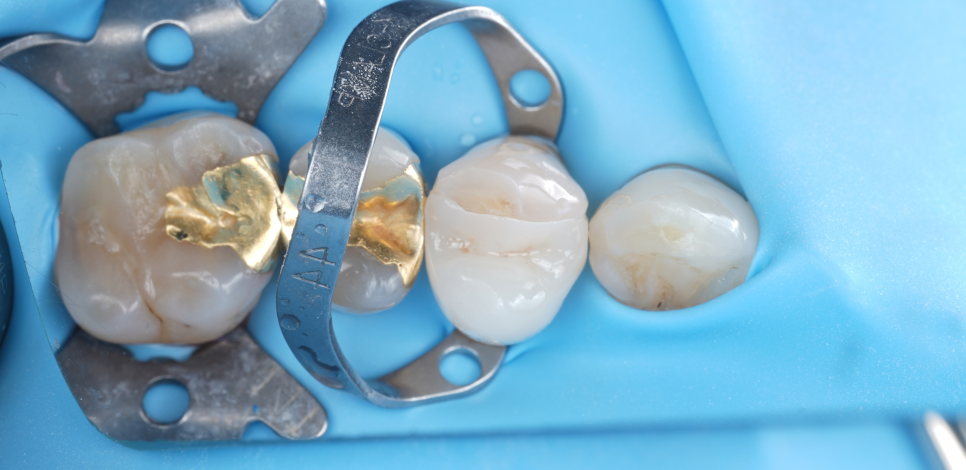 교대치과 신경치료 후 크라운 안 하고 오버레이로 보존 관련 이미지 13