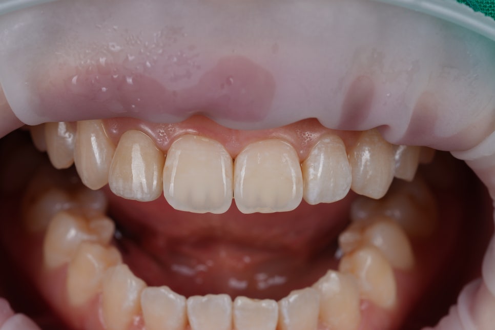 앞니 갈색 반점, 무삭제로 얼룩 제거 시술 : 아이콘 침투 관련 이미지 6