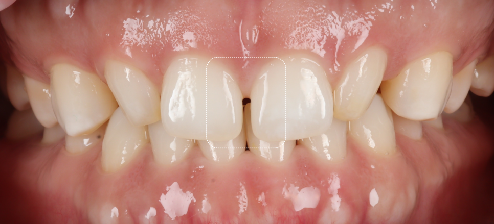 앞니 왜소치 레진 치과의사 소개로 내원해 당일 완료 관련 이미지 2