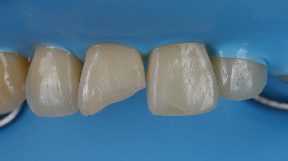 강남역치과 앞니 파절 크라운 말고 레진으로 하세요 관련 이미지 7