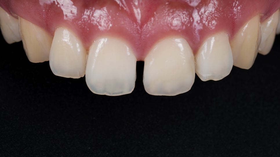 앞니 부러짐 레진, 크리스마스 이브날 앞니 복원 관련 이미지 1