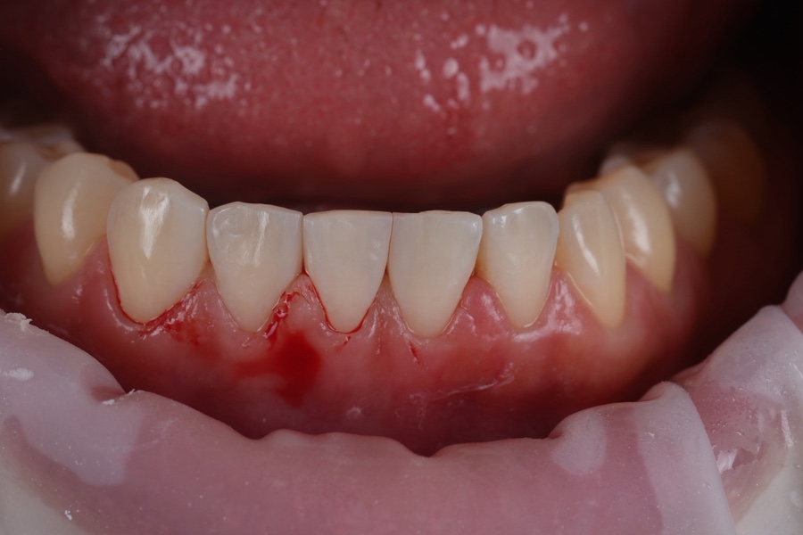 Multiple Gaps Between the Lower Front Teeth Below Gyodae Station—Filled in a Single Day image 4