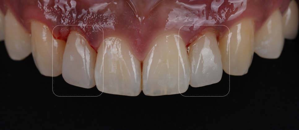 강남역치과 왜소치 레진 비니어로 삭제없이 가지런히 관련 이미지 9
