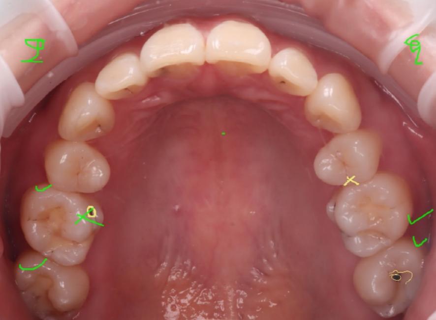 교대역치과 타치과 신경치료, 크라운 진단받았으나 레진으로 치료 관련 이미지 13