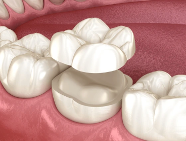 Gangnam Dental Clinic: You Wanted an Extraction, but We Preserved the Tooth with Root Canal Treatment + Overlay image 11