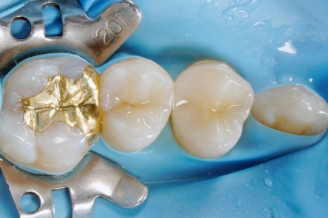 당신이 서울 교대역 재주좋은치과 라미네이트로 치료해야 하는 이유 관련 이미지 9