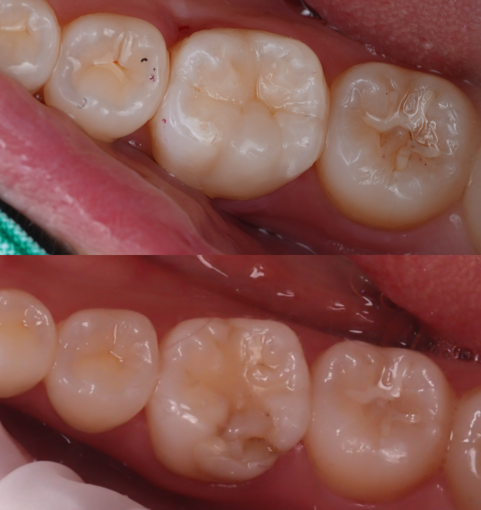 Jamnwon-dong Dental Clinic: Don’t Grind Down Your Teeth—Get Resin Build-up Instead image 11