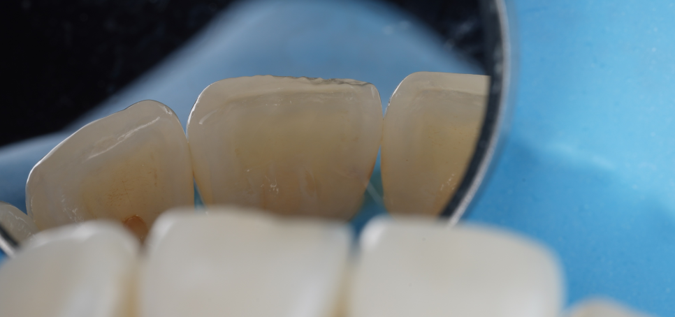 강남치과 짧아 보이는 치아 레진으로 당일 치료 관련 이미지 9