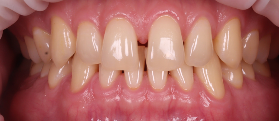 서울치과 앞니 레진 전 이걸 먼저 확인해야 돼요 관련 이미지 3