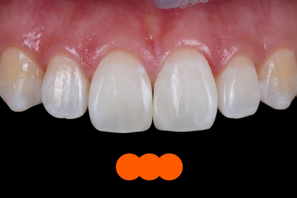 앞니 벌어짐 레진으로 삭제없이 충분히 예쁘게 할 수 있어요 관련 이미지 7