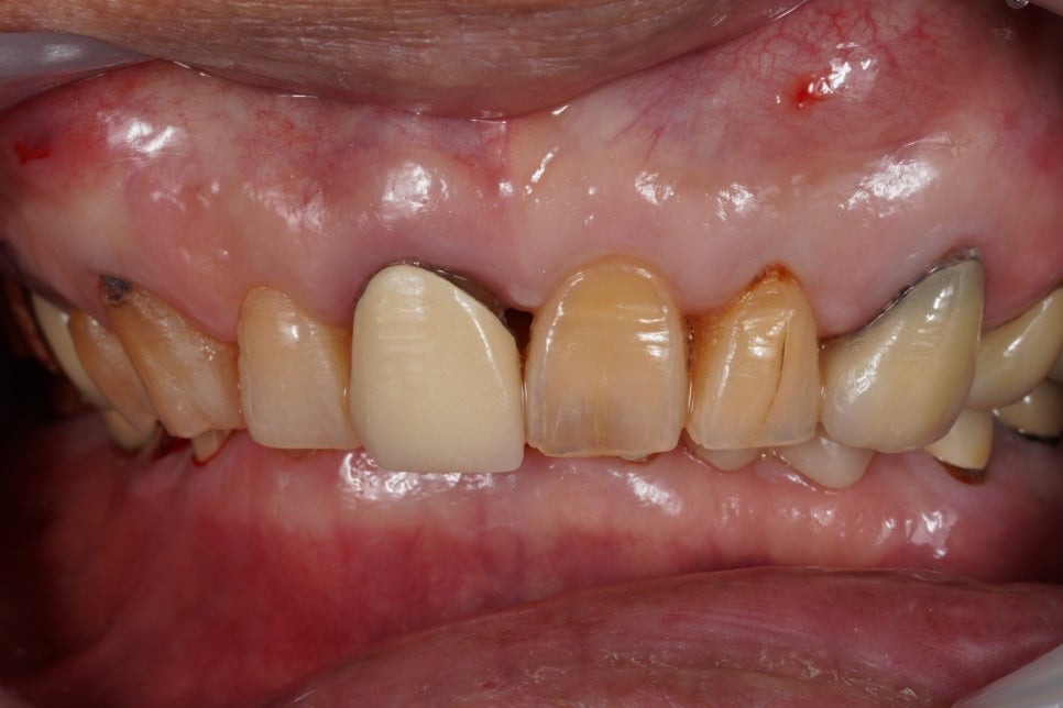 앞니 크라운 검은 선 단순한 보철 문제가 아닐 수도 있습니다 관련 이미지 3