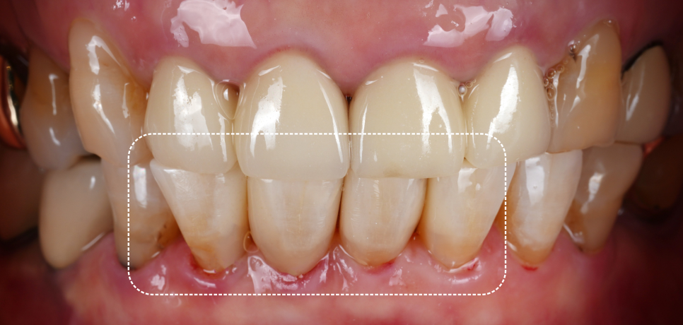 반포치과 70대 앞니 벌어짐 레진 당일 치료 케이스 관련 이미지 9