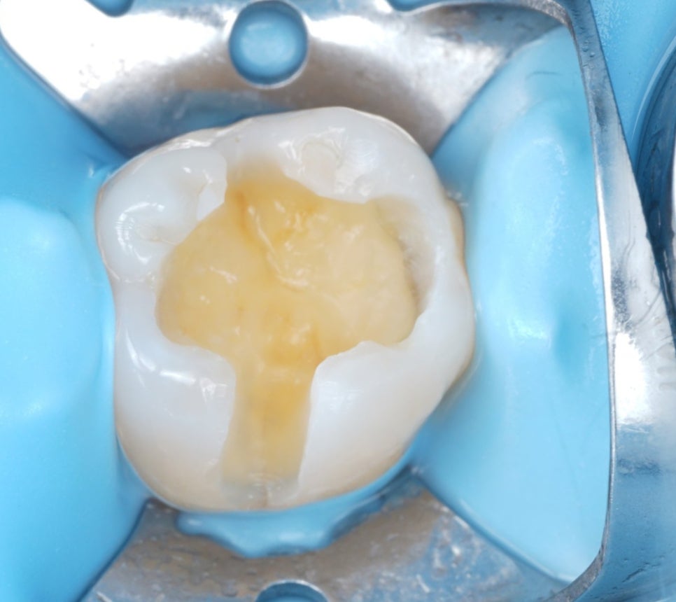 인레이치료 하방 2차 충치 레진 빌드업 사례 관련 이미지 8