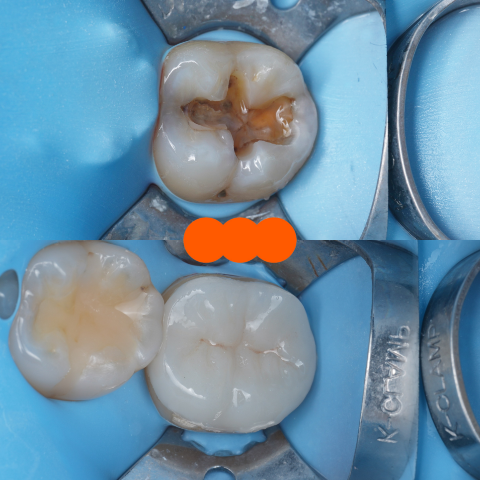 서초동치과 치아 삭제 원하지 않는다면 오버레이 하세요 관련 이미지 12