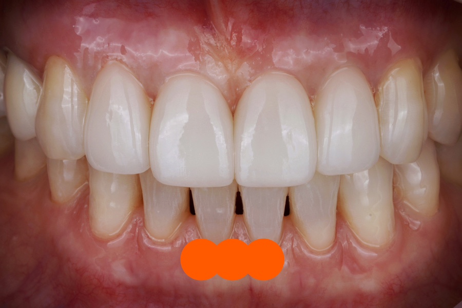 무삭제 라미네이트 잘하는 치과, 중요한 건 치아의 &lsquo;분리감&rsquo; 관련 이미지 3