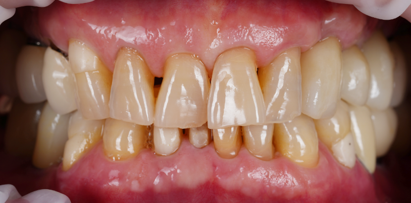 선릉역치과 타원 앞니 임플란트 빼고 재수술 해드린 이유 관련 이미지 9