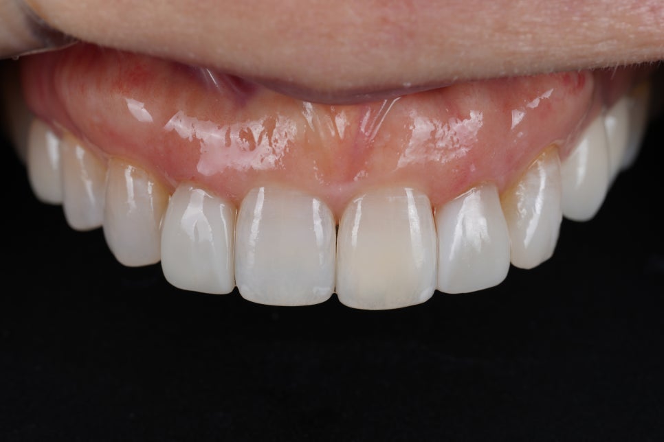 앞니 레진 라미네이트, 1시간 원데이 치료가 가능한 교대 치과 관련 이미지 2