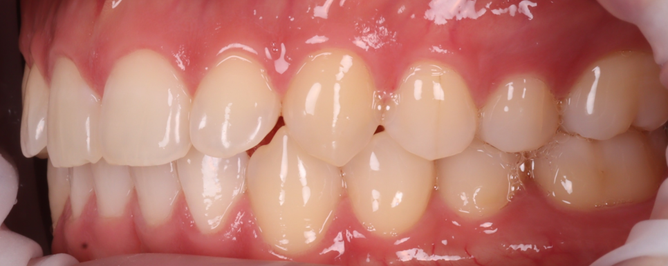 Apgujeong Dental Clinic: 3 Things Needed for Successful Resin Treatment of Peg Laterals image 5