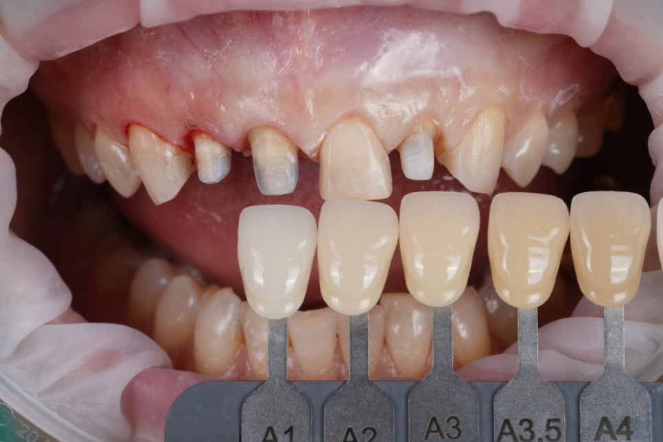 라미네이트, 크라운 재치료, 잇몸 성형까지 앞니 6개 치료 관련 이미지 9