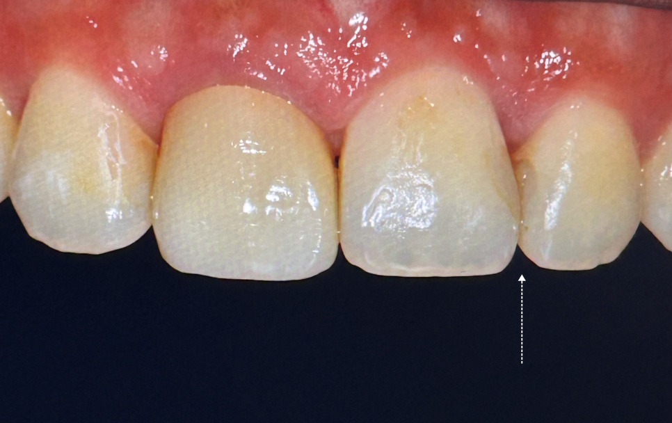 서초동치과 전라도 광주에서 레진 재치료 받으러 오신 사례 관련 이미지 5