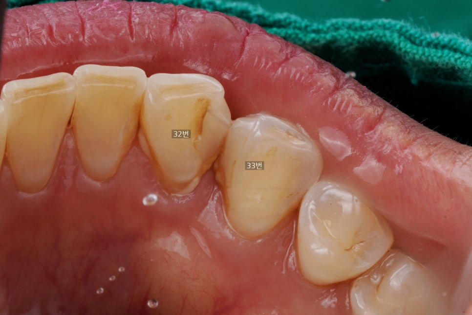 20년 전 때운 레진 떨어짐으로 이 사이 벌어짐 치료 : 교대역 치과에서 당일 레진 관련 이미지 3