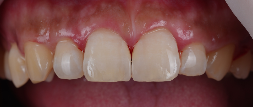 양재역치과 앞니 레진 받으러 수원에서 오신 이유(feat. 치과의사 소개) 관련 이미지 9