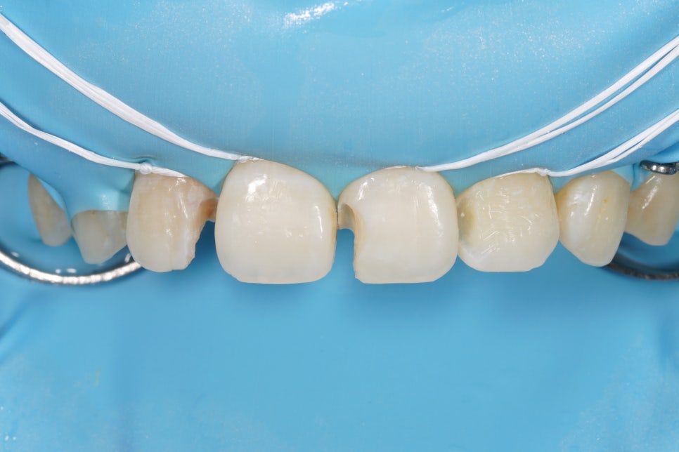 교대역, 교정 끝나고 앞니 사이 충치 레진 재치료 (유지장치 붙이기 전에 오세요) 관련 이미지 5