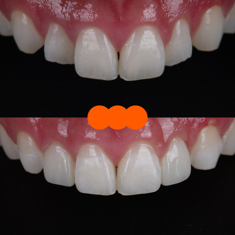 If Your Front Teeth Look Extra Large, Be Sure to Read This — Gyodae Station Dental Clinic image 11