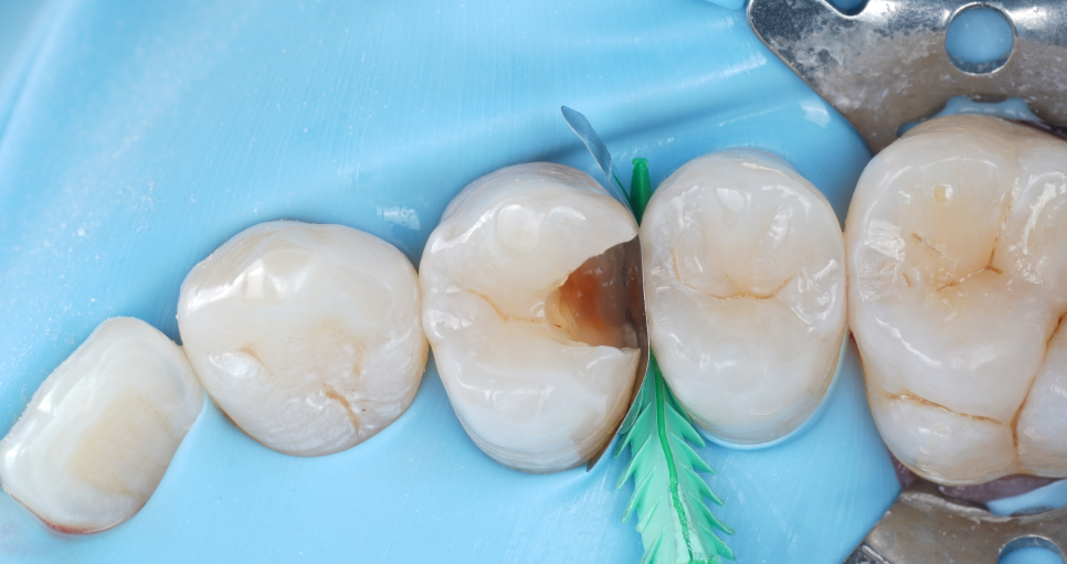 강남역치과 치료 부위 2차 충치 레진 재치료 사례 관련 이미지 10