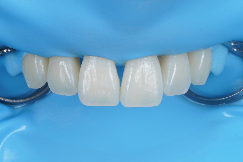 블랙 트라이앵글 (블트) 레진으로 건강하게 치료하는 방법 관련 이미지 4