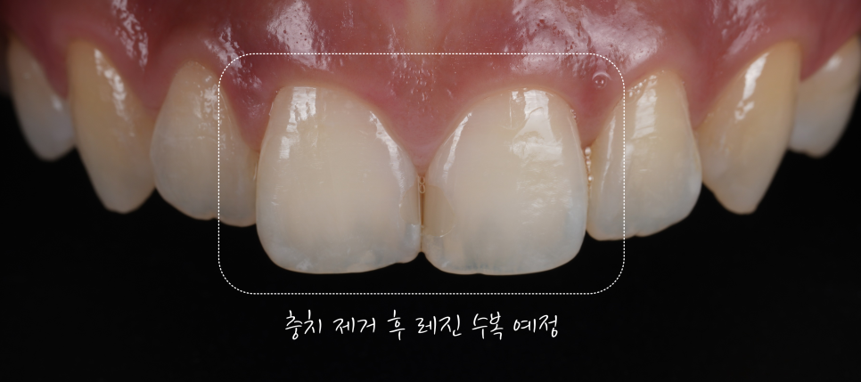 앞니사이충치 레진으로 치아성형 효과까지 낼 수 있어요 관련 이미지 5
