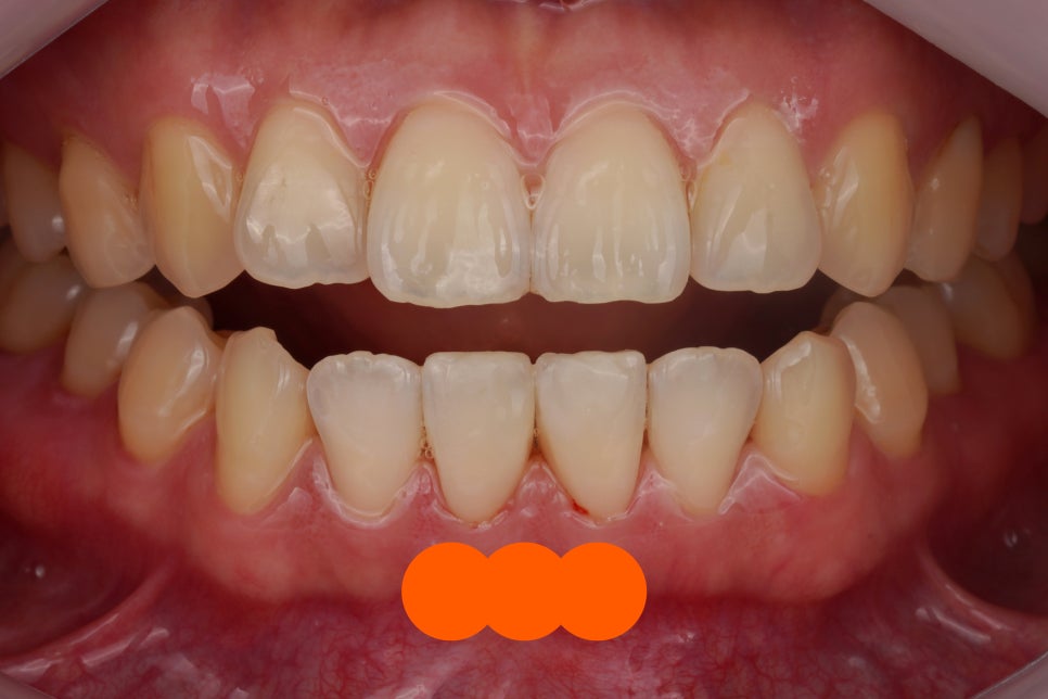 앞니 벌어짐 레진 당일 치료, 앞니 레진 잘하는 서초동 치과 관련 이미지 2