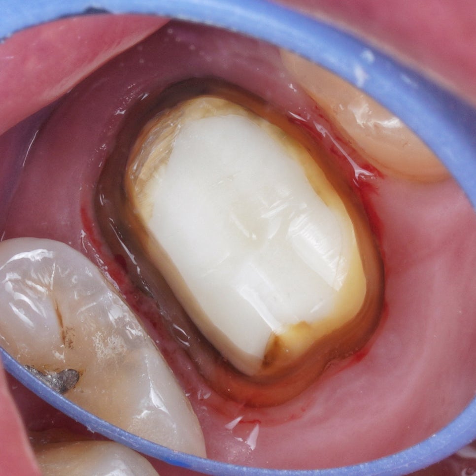 부모님(아버지) 어금니 재신경치료 해드린 썰 푼다.txt 관련 이미지 5