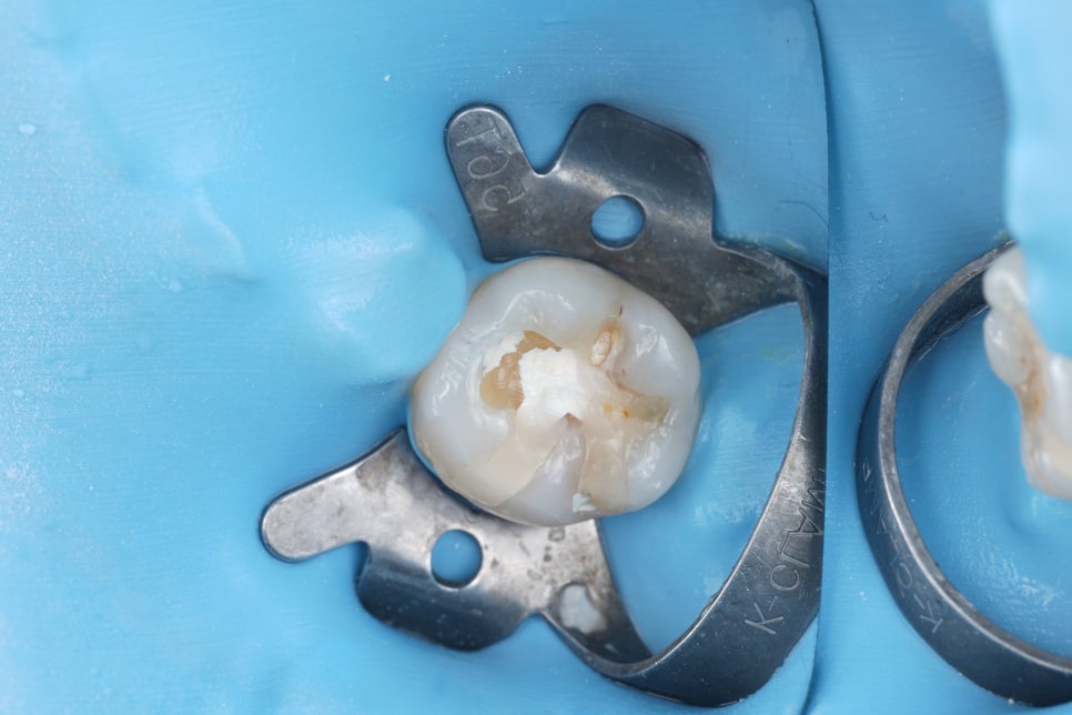 교대역치과 타치과 신경치료, 크라운 진단받았으나 레진으로 치료 관련 이미지 19