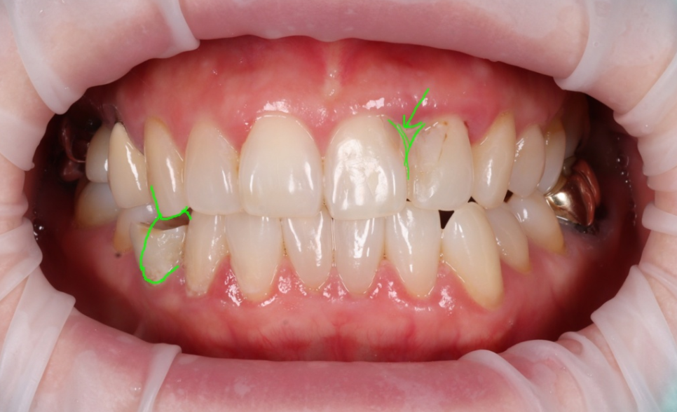 잘못된 앞니 레진 뼈까지 녹인다? 레진 재치료 과정 관련 이미지 7
