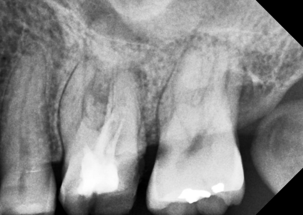 부모님(아버지) 어금니 재신경치료 해드린 썰 푼다.txt 관련 이미지 2