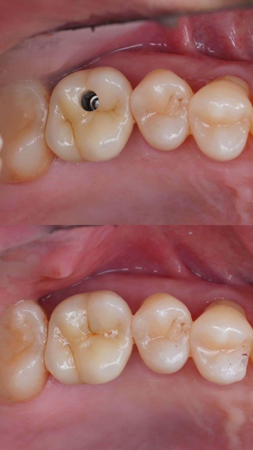 임플란트 구멍, 레진 빌드업으로 메우기 관련 이미지 3