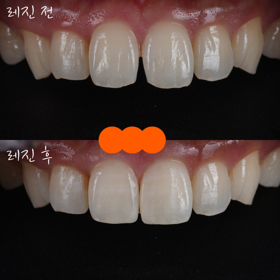방배동치과 누렇고 벌어진 치아 미백과 레진 치료 관련 이미지 11