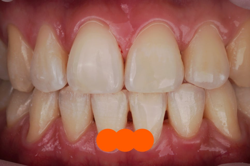 치과의사의 치아 살짝 깨짐, 레진으로 치료한 서초동 치과 관련 이미지 6