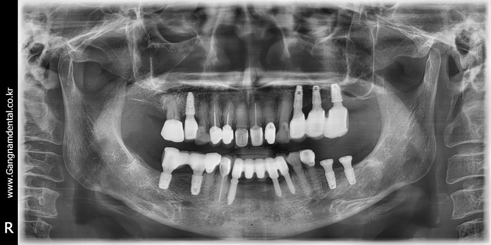 야, 너두 임플란트 할 수 있어 <책> 김영삼 원장의 임플란트 달인되기 관련 이미지 2